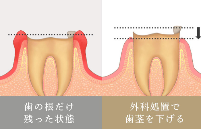 歯冠長延長術