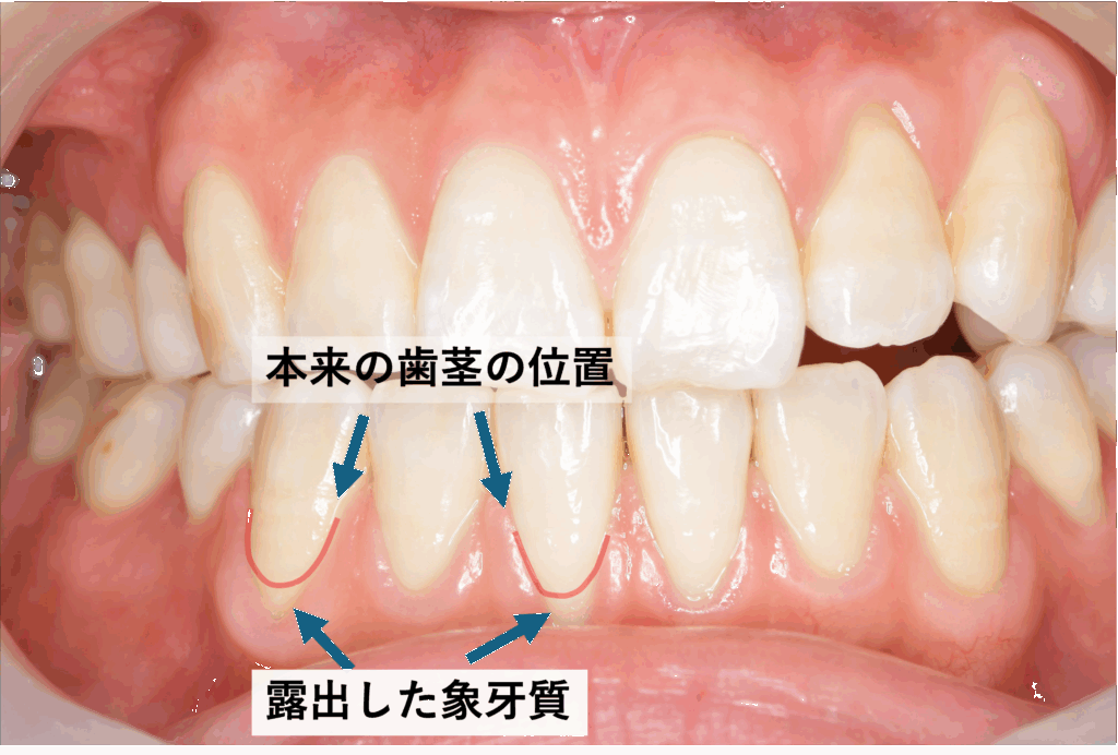 歯肉退縮の写真、露出した象牙質、知覚過敏