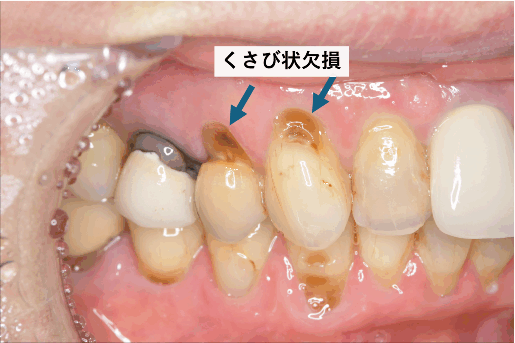 くさび状欠損の写真、知覚過敏